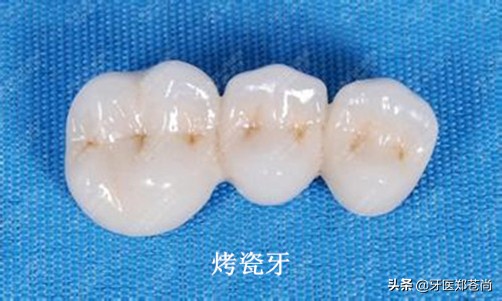 为什么做了烤瓷牙牙齿会疼,为什么做烤瓷牙往牙根里打钉子