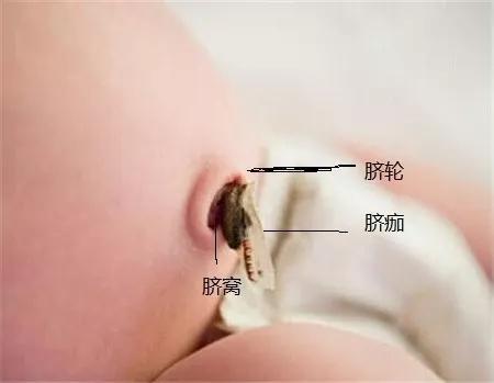 宝宝肚脐突然渗血多怎么回事,新生儿脐带脱落后肚脐出血的护理