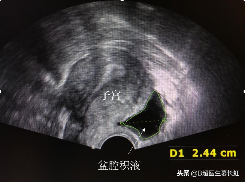 月经前期有盆腔积液小肚子痛,男孩盆腔积液会导致肚子痛吗