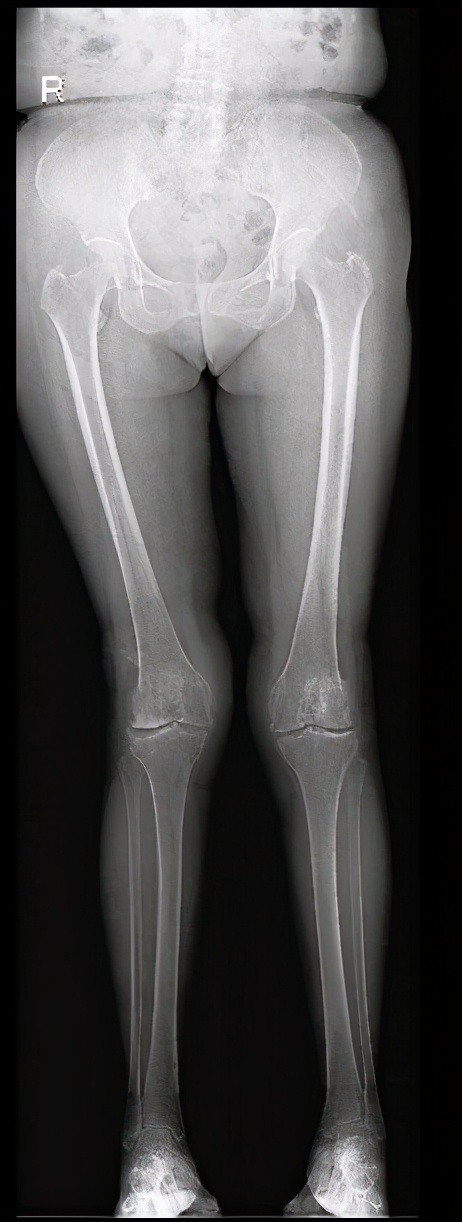 膝关节阶梯治疗ppt,膝关节骨性关节炎阶梯化治疗
