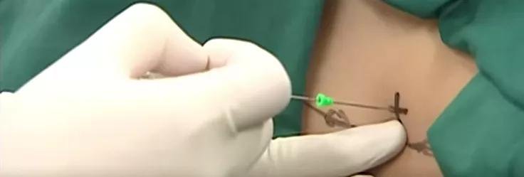 镇痛注射教学视频,疼痛科注射药物及方法