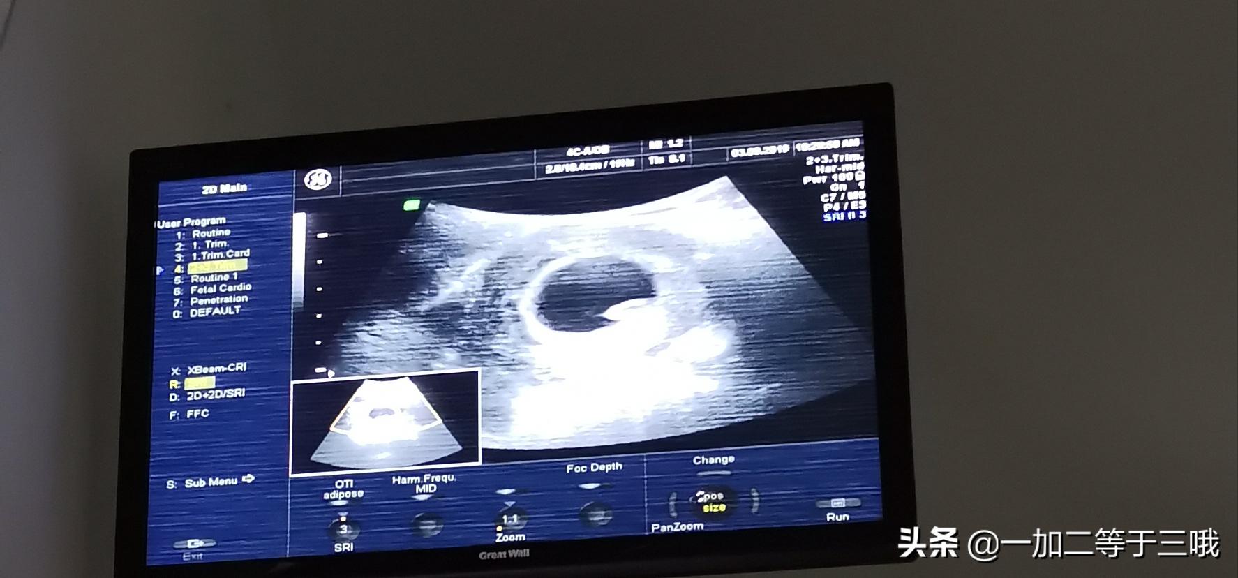 分享自身经历的孕期奇迹,回忆自己怀孕的艰辛