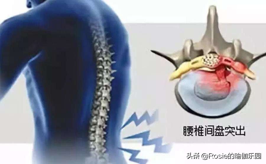 运动量过大腰疼怎么恢复,产后腰痛膝盖痛怎么锻炼