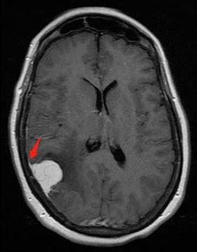 脑膜瘤有些什么症状,脑膜瘤症状有哪些啊
