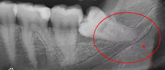 智齿到底要不要拔医生告诉你答案,智齿必须拔掉的五种情况
