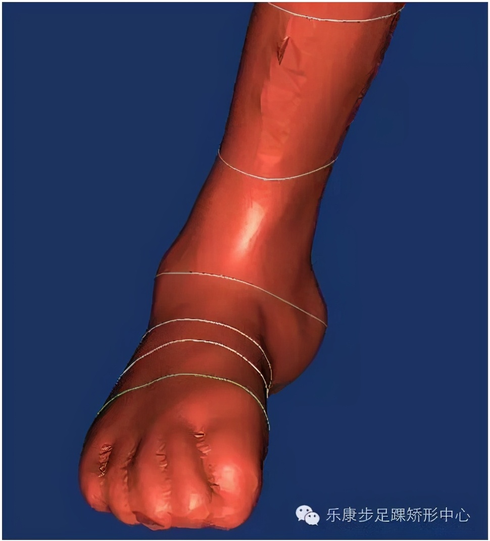 孩子有点内八字怎么矫正,一招解决儿童内八字