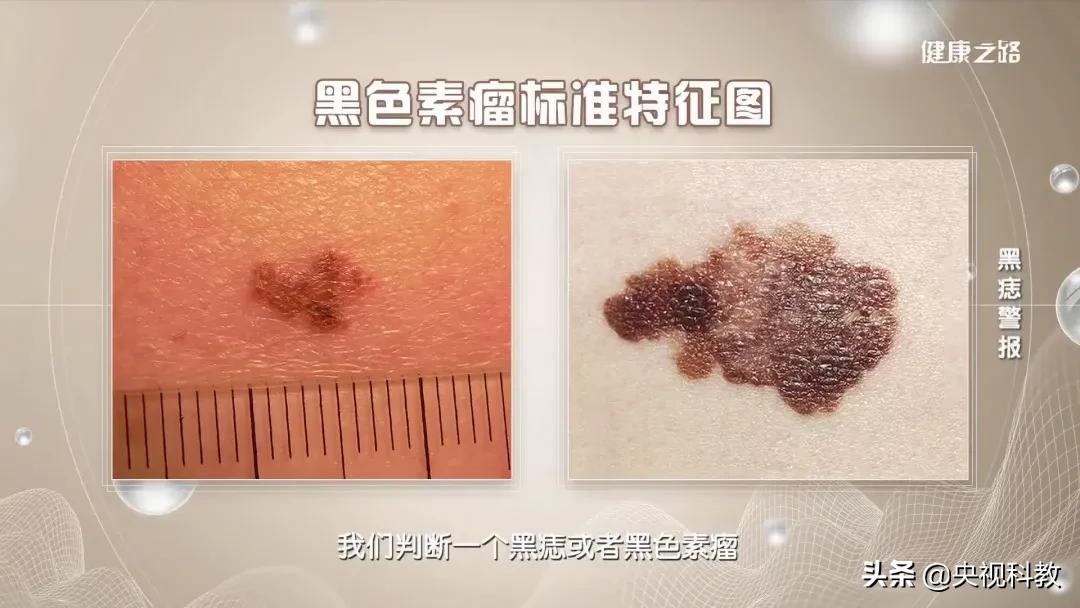 黑痣很容易恶变吗,身上黑痣出现什么状况有癌变发生
