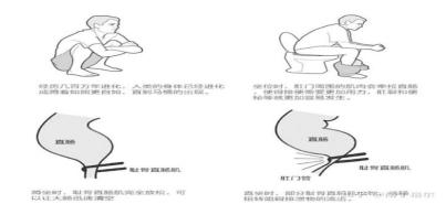 肛裂每次大便都血淋淋,肛裂致死