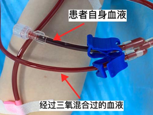 打臭氧针治关节炎有副作用吗,关节疼痛可以用臭氧注射吗