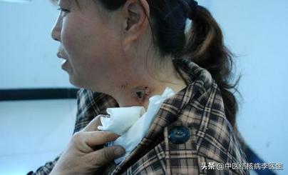 肺外结核——颈淋巴结结核