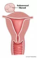 子宫肌瘤是什么症状会死人吗,子宫肌瘤出现哪些应警惕癌变可能