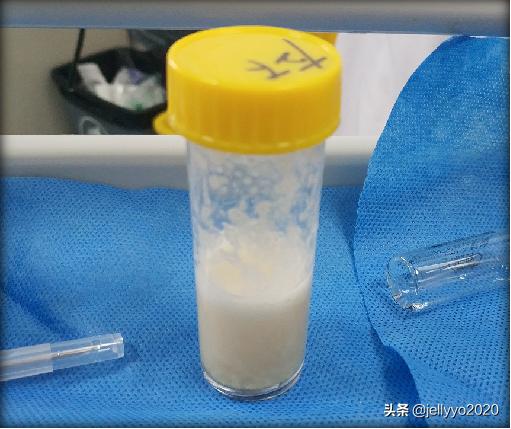 支气管镜灌洗和肺泡灌洗一样吗,支气管肺泡灌洗术示意图