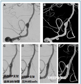 盖延廷大动脉瘤复查,夹层动脉瘤支架治疗