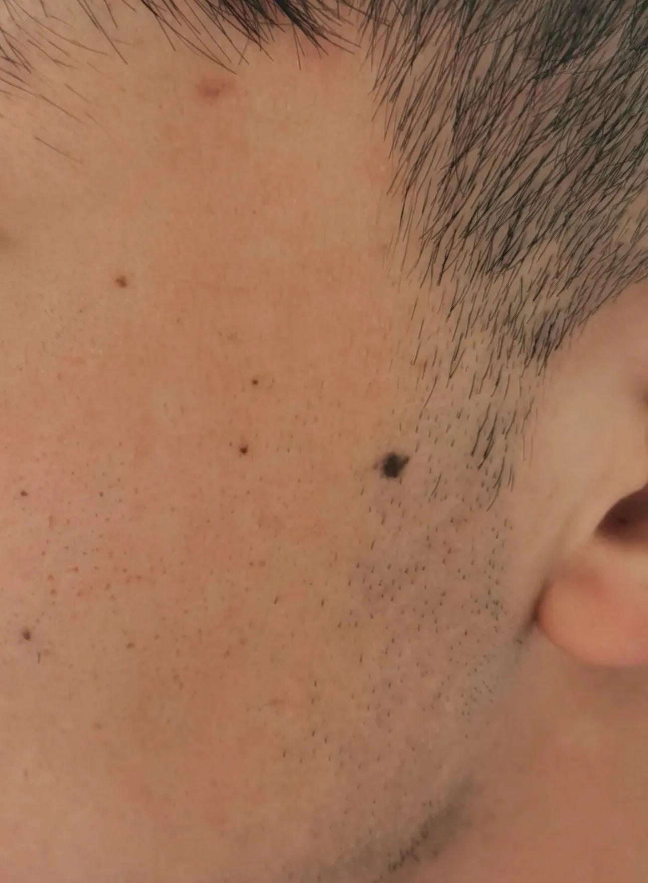 长在皮肤里面的痣激光好祛除吗,去除脸上的痣是冷冻好还是激光好