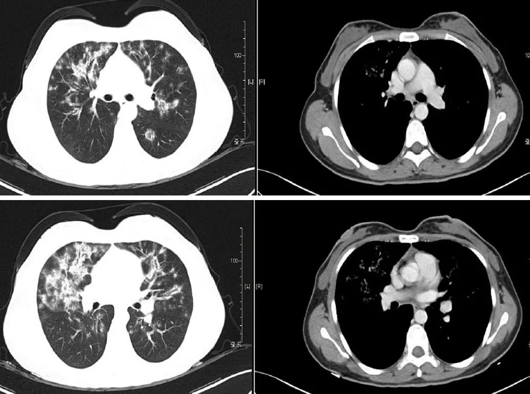 特发性肺炎一直用激素治疗,机化性肺炎住院治疗使用什么药物