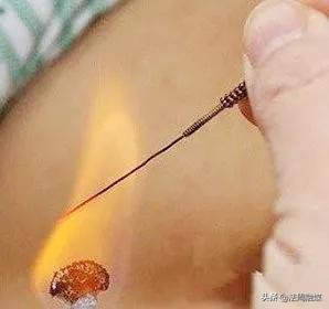 长痘发痒越来越大化脓,起痘瘙痒