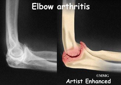 “医生,我胳膊肘伸不直了,还用不了筷子了,我是怎么了啊?”