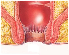 “菊花”不适，不一定都是“痔疮”的锅