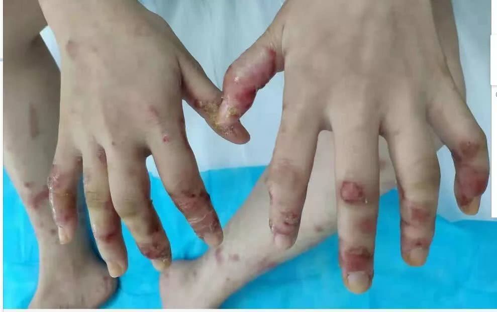 江门新会一少女天天吃鱼，手脚竟“满目疮痍”！医生一句话说出真相