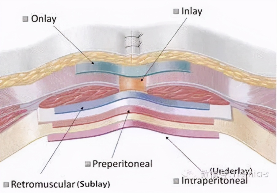 脐疝如何治疗效果好,脐疝怎么治疗最快最好的方法
