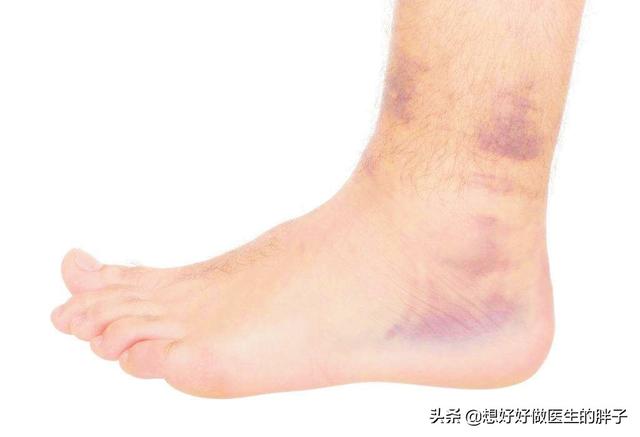您重视过踝关节扭伤吗?扭伤3个月还不好,我们应该做点什么呢?
