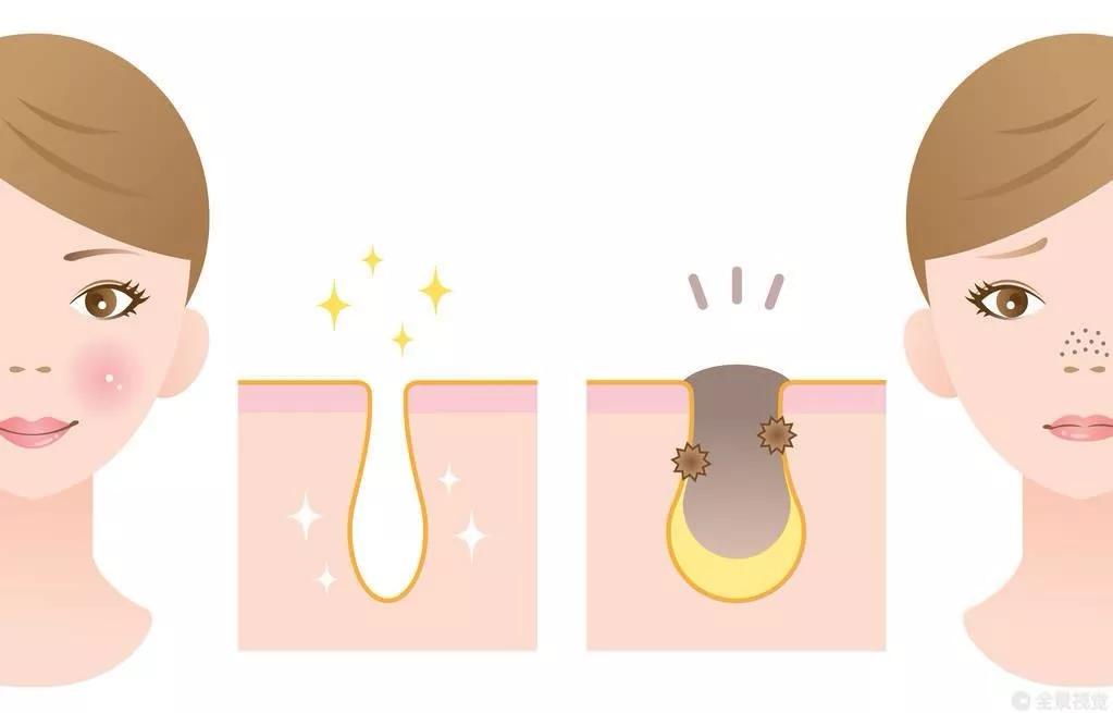 甲硝唑凝胶草莓鼻敷多久,怎么正确使用甲硝唑凝胶