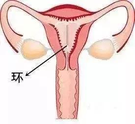 女人上环后身体会排斥,三招做好保养!你都知道?