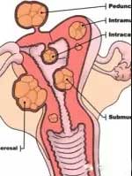 子宫肌瘤腺肌症微创介入科普动画,子宫肌瘤适合微创手术吗