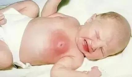 还在给新生儿挤乳头?这种糟糕习俗危害大到抱憾终身