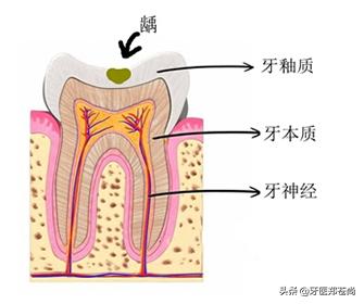 牙齿根管治疗1200跟900有什么区别,根管治疗过后牙齿还会长吗