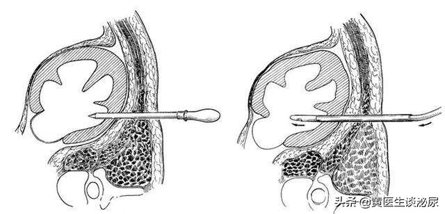 如果得了肾结石是不是必须碎石,如果得了肾结石如何治疗好