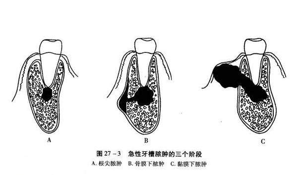 根治牙龈肿痛特效药,牙龈肿痛的三个真相