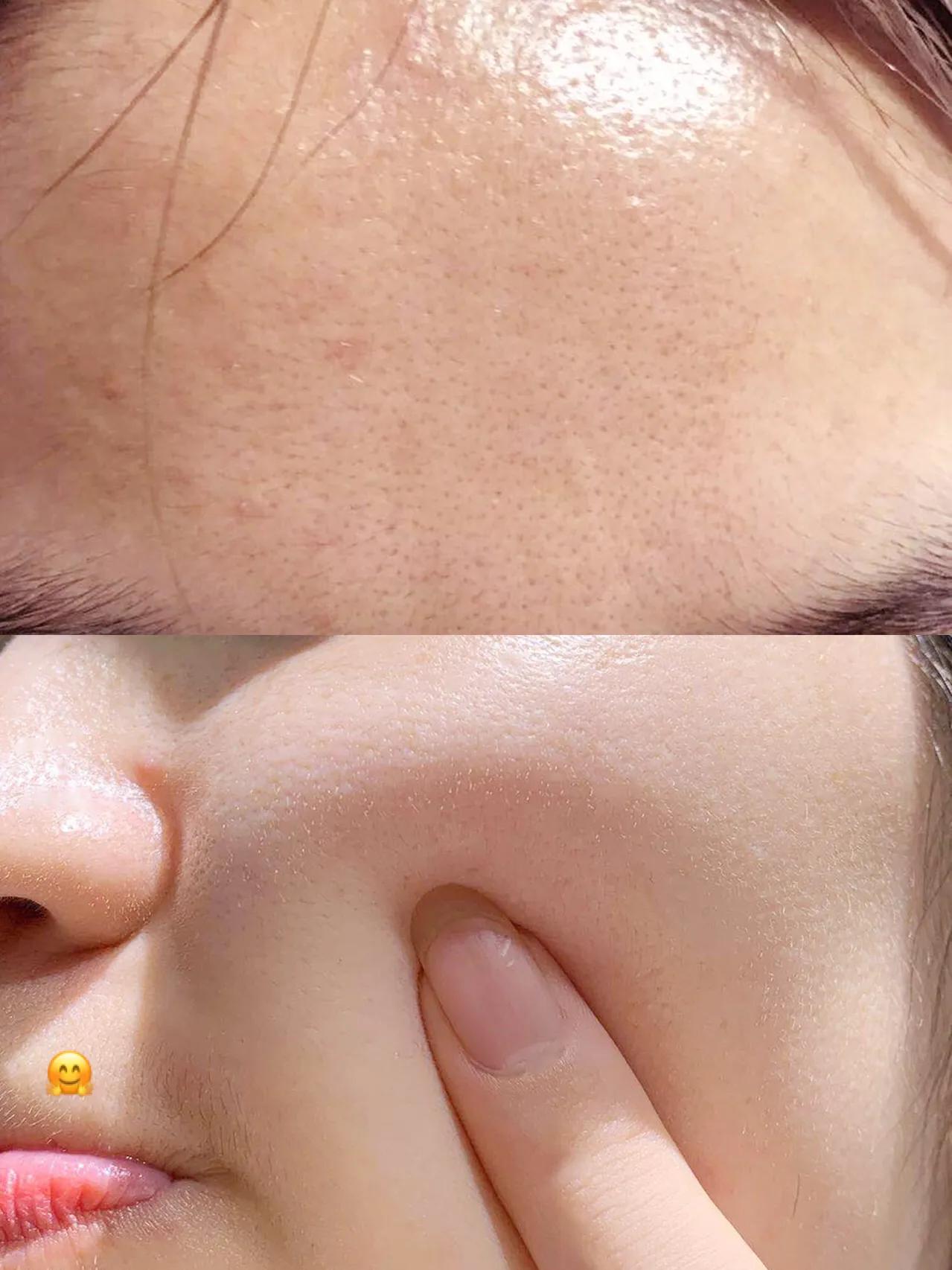 油痘肌不长痘痘了是不是快好了,油痘肌的痘痘