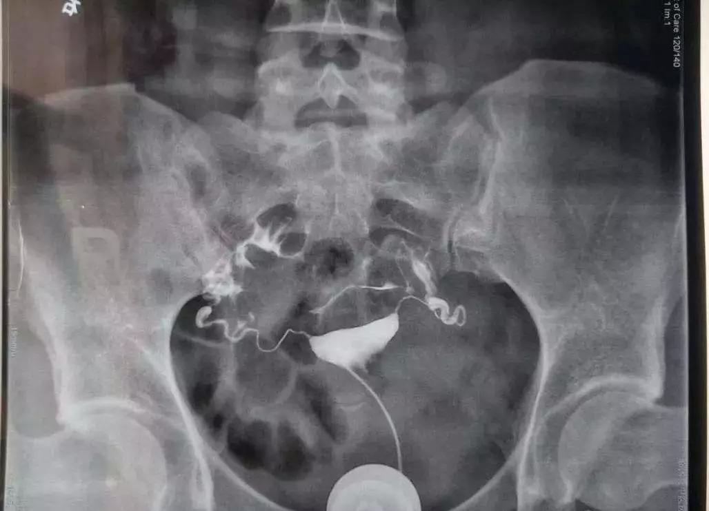 想要个宝宝，却遇上输卵管阻塞，该怎么办？