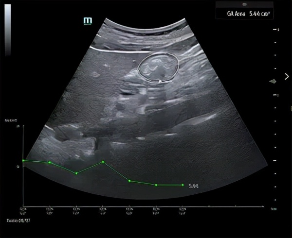 业内首个！迈瑞TE9超声新增这一功能