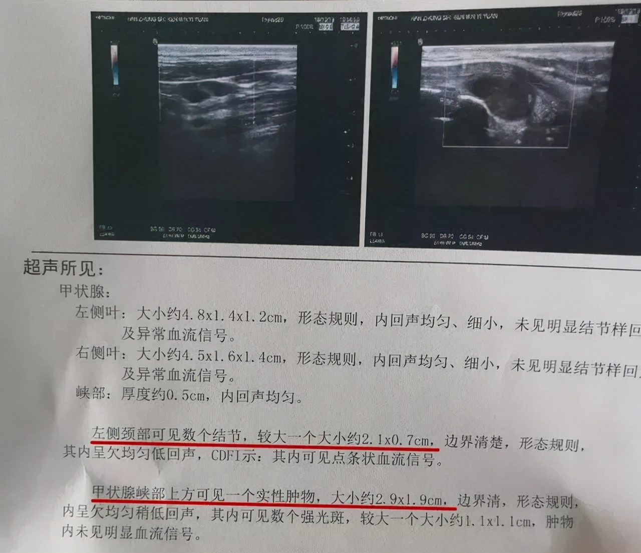 甲状腺结节开刀还是消融手术好,甲状腺结节什么条件符合消融手术