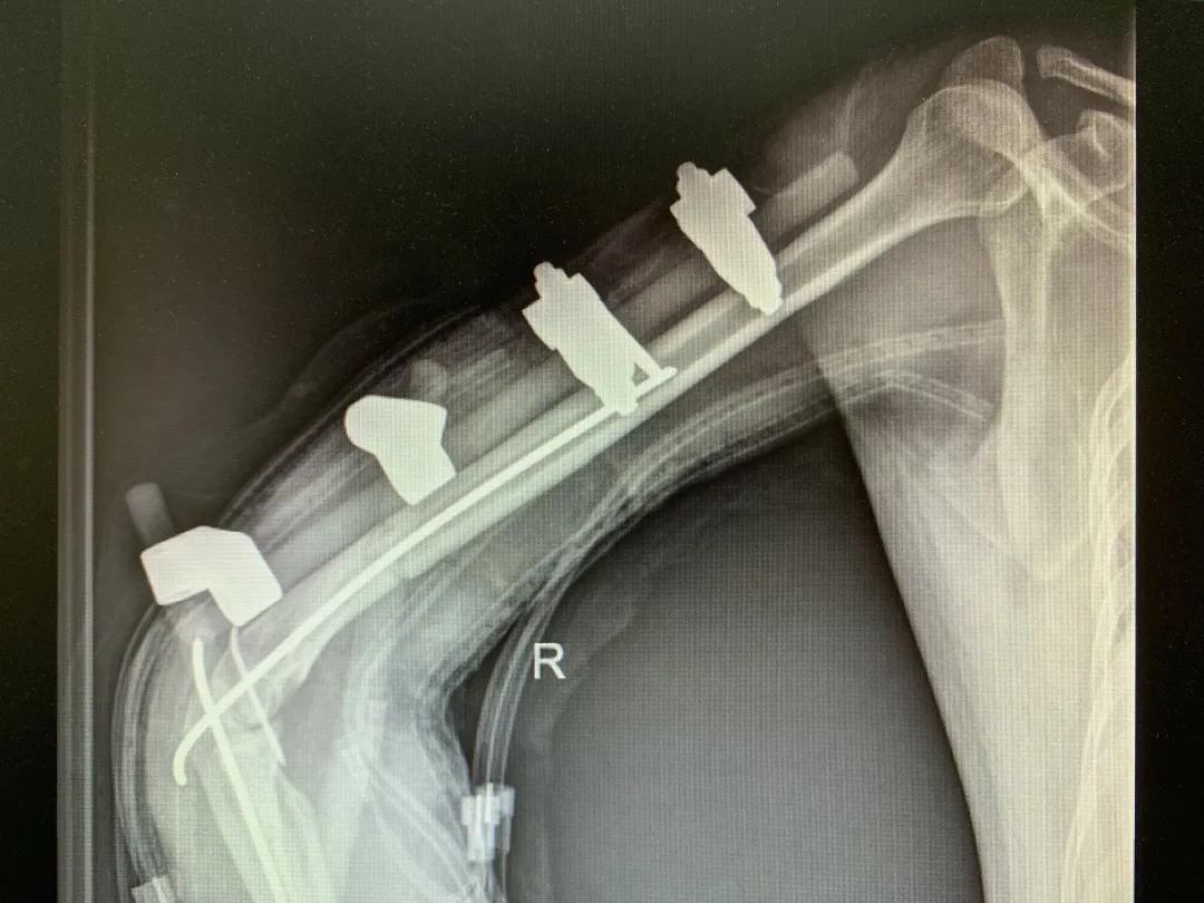 【日照市人民医院】右臂卷入机器被撕裂 6.5小时成功复活