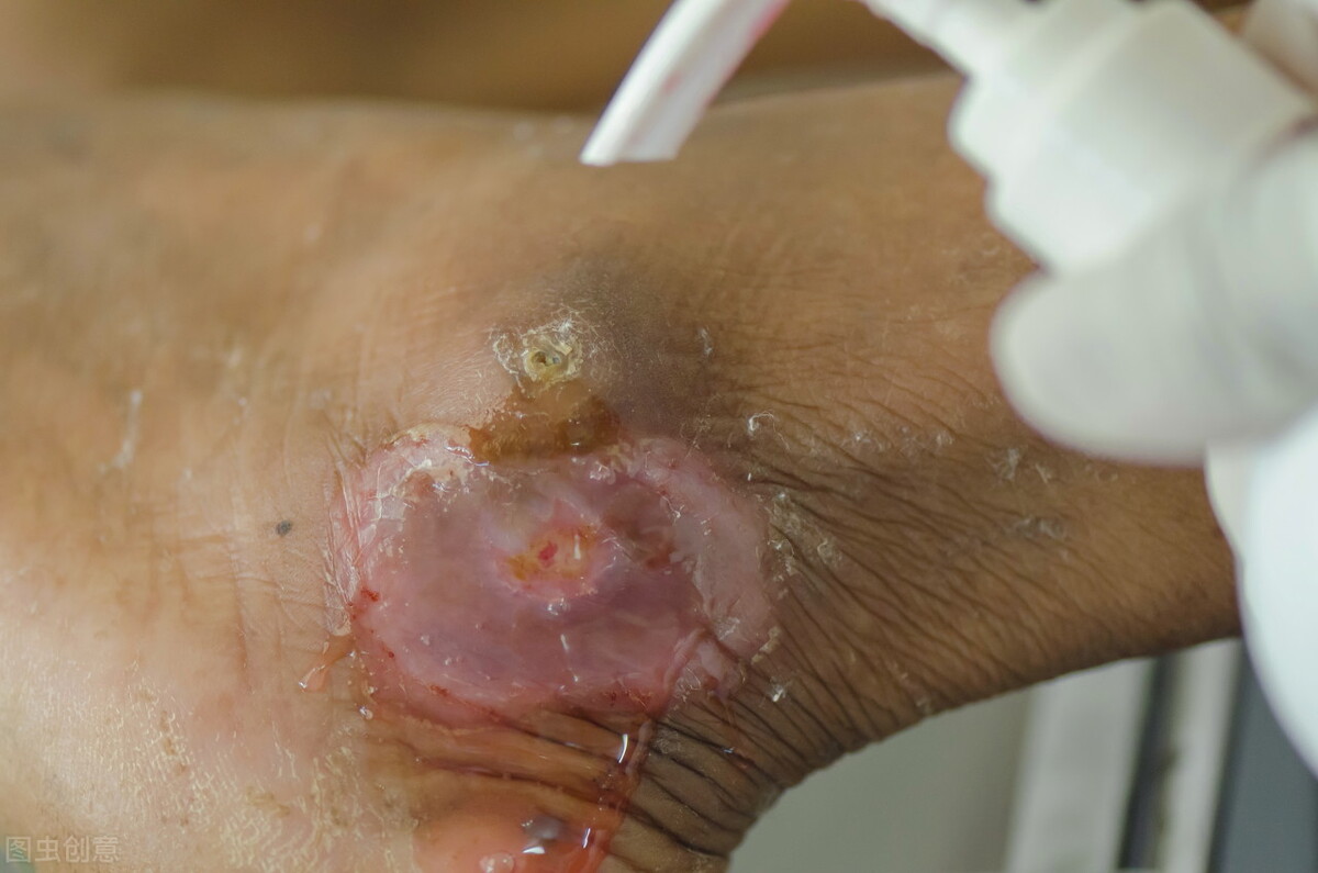 糖尿病足坏疽溃烂是糖尿病晚期吗,糖尿病病足坏疽并感染的护理措施