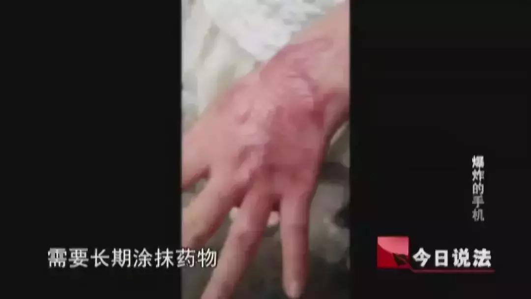 电池爆炸烧伤4岁女孩,手机爆炸小孩被毁容