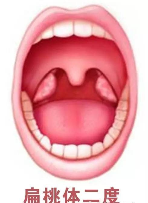 急性化脓性扁桃体炎有多痛,急性扁桃体炎咽部疼痛与什么有关