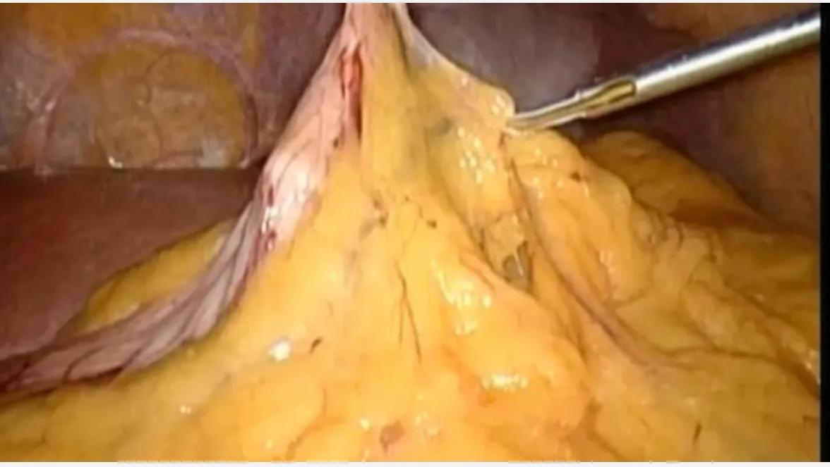 腹腔镜胰体尾切除术打孔位置,胰体尾肿瘤切除后复查哪些