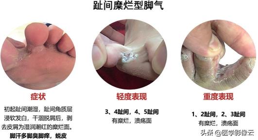 足部扁平苔藓,足癣病例