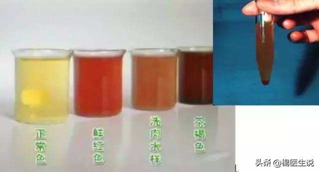 尿蛋白2+隐血3+白细胞3+严重吗,尿潜血3+白细胞3+怎么回事