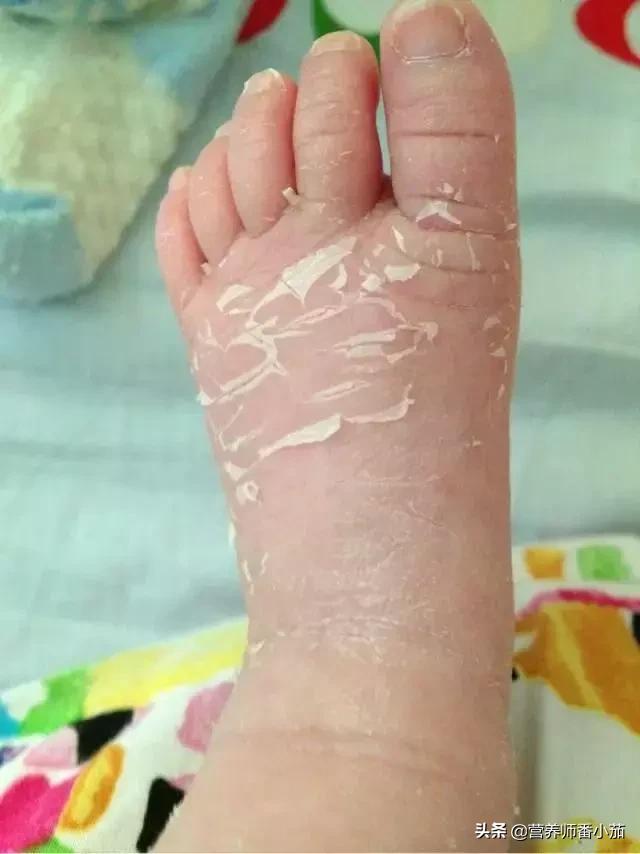 粟粒疹宝宝,宝宝红斑丘疹鉴别图谱