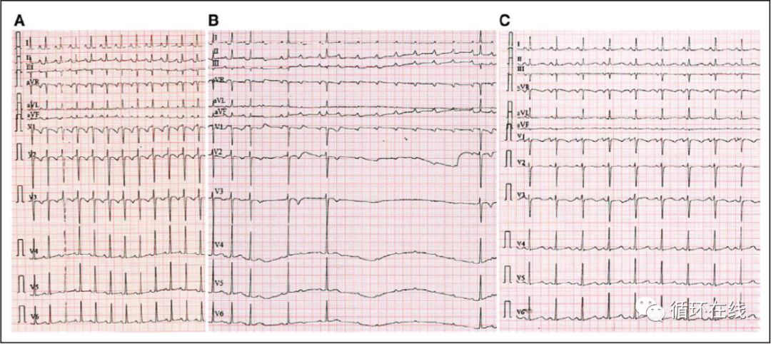 「彤心飞传」局灶房性心动过速治疗的新策略:伊伐布雷定