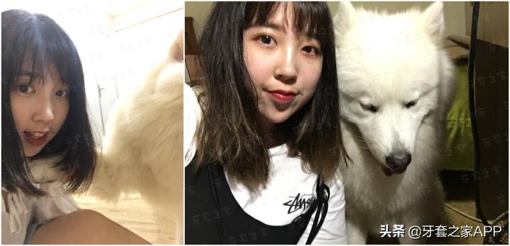 不靠整容怎么改变下巴后缩?看这里