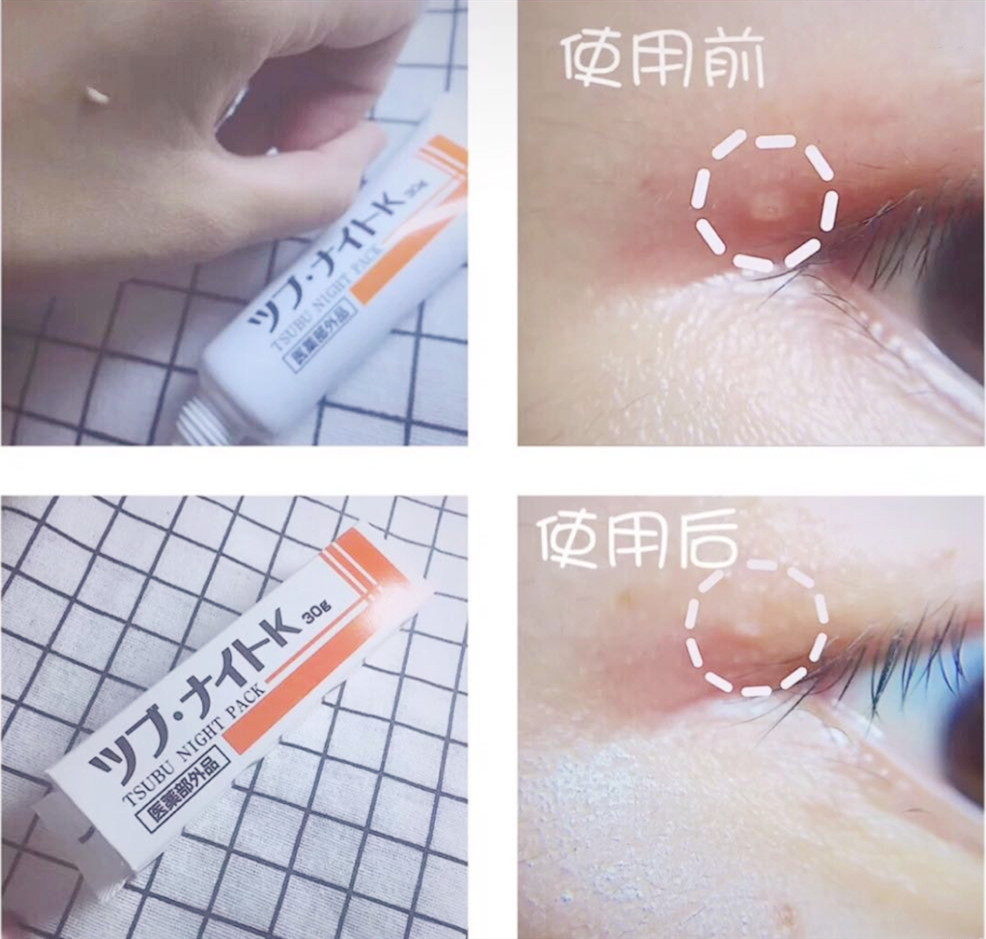 手动去脂肪粒工具,去脂肪粒神器排行榜