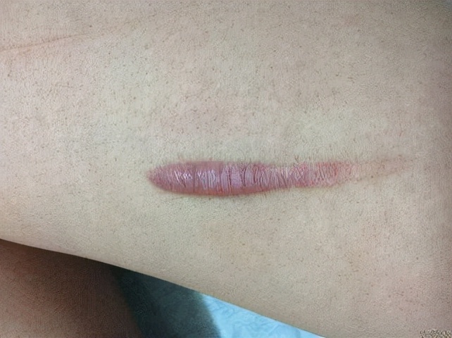 凸起的增生疤手术切除,增生性凸疤可以激光去掉吗