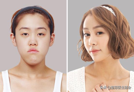 面中部凹陷下巴微翘,朱元璋式下巴怎么矫正