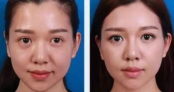 线雕热玛吉拉皮超声刀的区别,热玛吉超声刀线雕后遗症有多严重